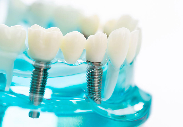 implant dentar sibiu